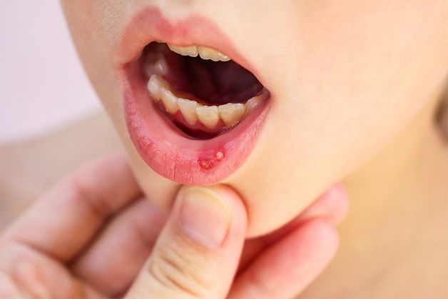 thuốc bôi nhiệt miệng hiệu quả