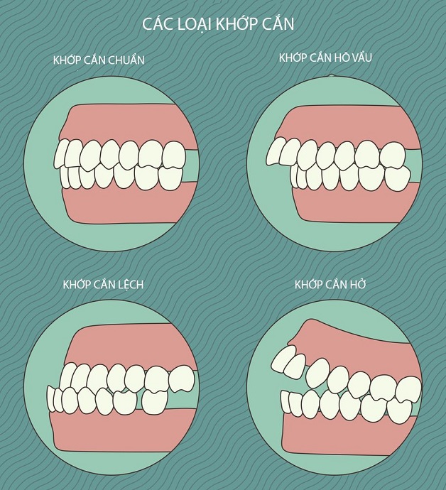 Các trường hợp lệch khớp phổ biến