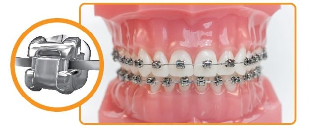 Niềng răng mắc cài tự động được sử dụng phổ bién