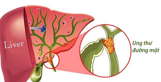 Polyp túi mật 10mm có thể gây ra ung thư