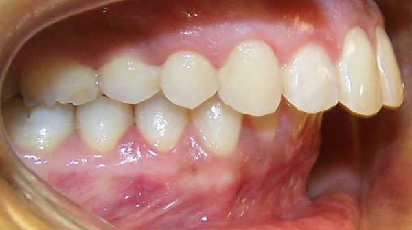răng cửa bị hô là mtooj trong những trường hợp được bác sĩ chỉ định chụp răng sứ