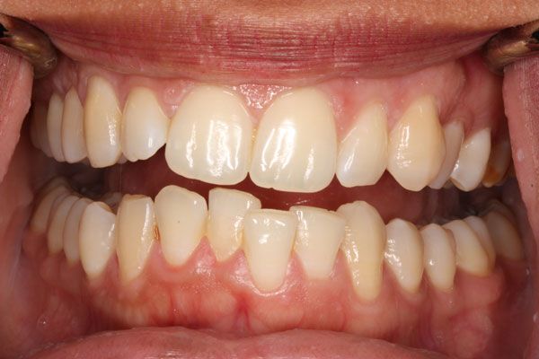 Răng khấp khểnh gây nên tình trạng mất thẩm mỹ cho hàm răng và bệnh nhân gặp khó khăn trong việc vệ sinh răng miệng