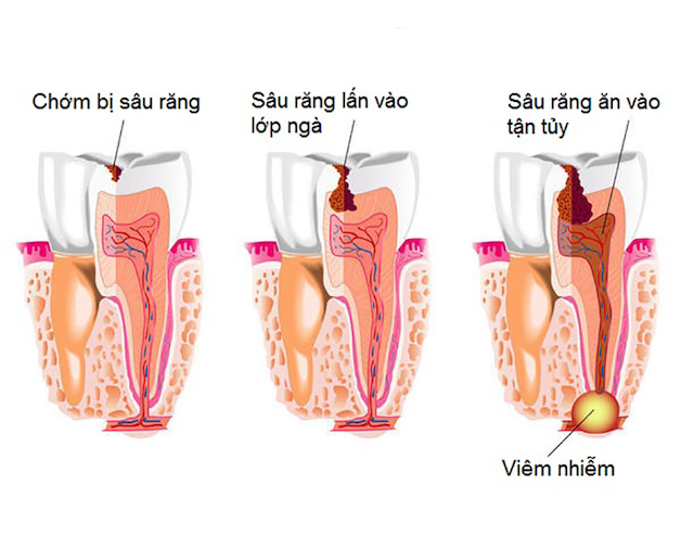 Bệnh sâu răng là nguyên nhân gây viêm tủy răng hàng đầu.