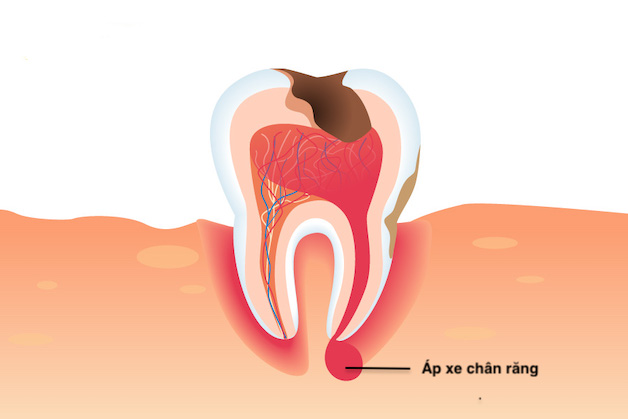 - Viêm tủy răng khôn nhanh chóng dẫn đến viêm lợi và áp xe chân răng.