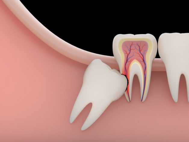 đặc điểm của răng khôn