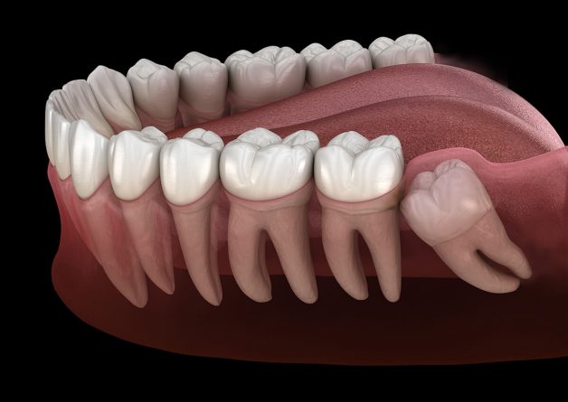 Trường hợp răng khôn mọc lệch, ảnh hưởng đến những răng lân cận sẽ được chỉ định nhổ bỏ