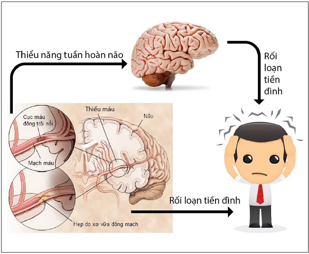 rối loạn tiền đình thiếu máu não có mối quan hệ mật thiết với nhau.