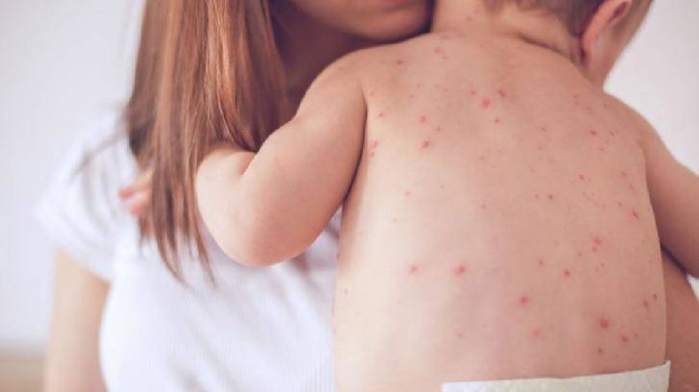 Sốt phát ban là căn bệnh thường gặp ở trẻ nhỏ