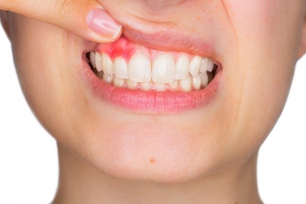 Khi nướu bị viêm nhiễm, các hạch lympho ở vị trí lân cận sẽ nổi lên để bảo vệ các mô nướu khỏi sự tấn công của vi khuẩn - tác nhân gây bệnh.