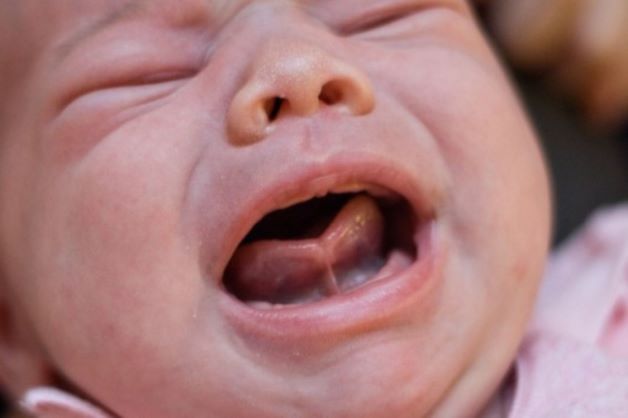 Dính thắng lưỡi ở trẻ em là tật bẩm sinh nhẹ do lớp mỏng niêm mạc ở dưới lưỡi bị ngắn hoặc quá dày, dính chặt và làm hạn chế cử động lưỡi của trẻ.