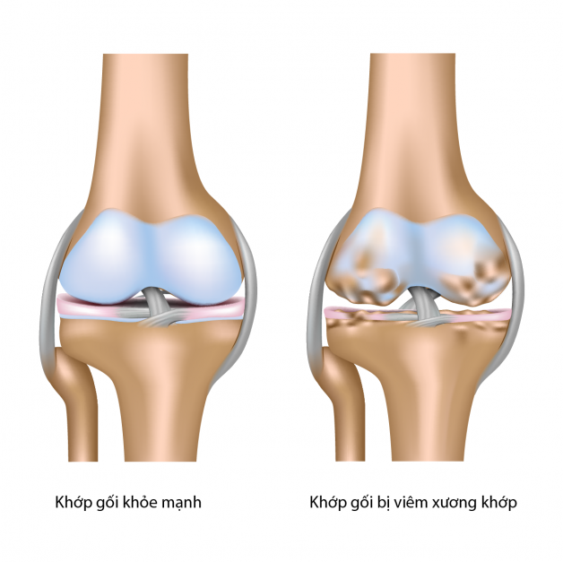 Biểu hiện của người bệnh cần thay khớp nhân tạo