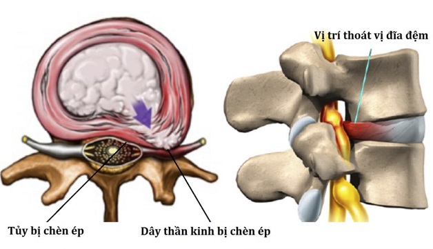 thoát vị đĩa đệm chèn ép tủy sống và các dây thần kinh gây đau đầu và nhức mỏi vai gáy
