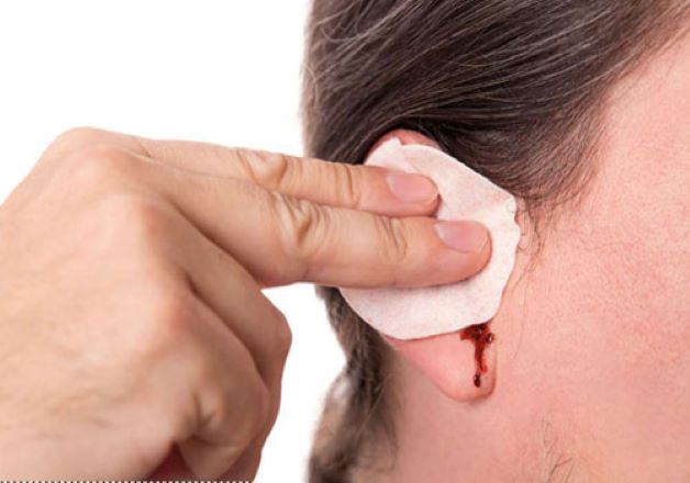 Người bị thủng màng nhĩ có chảy nhiều máu không?