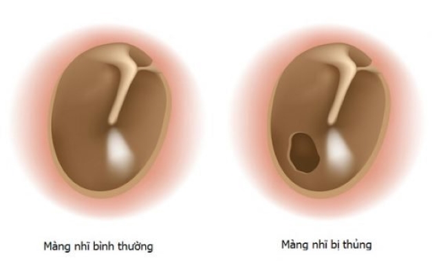 Thủng màng nhĩ chảy máu không?