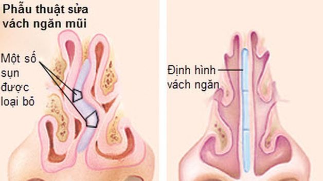 phẫu thuật chỉnh hình vách ngăn mũi qua nội soi