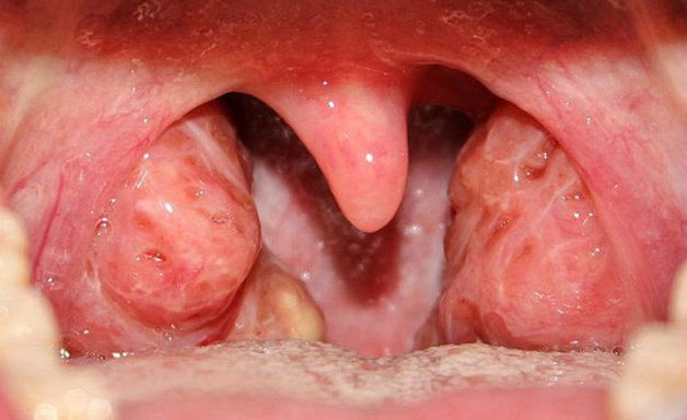 Amidan là một tổ chức lympho lớn nhất của cơ thể, bảo vệ cơ thể chống lại sự xâm nhập của vi khuẩn