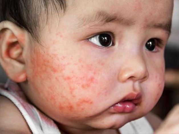 Nếu vùng da ở hai bên má có những mảng ban đỏ hồng và các nốt mụn nước liti thì có thể bé yêu đã bị chàm sữa.