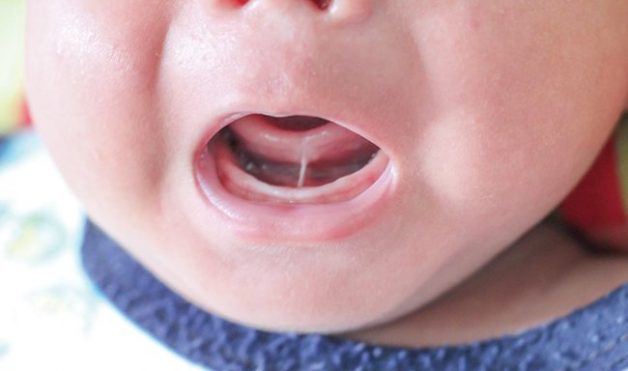 Khi bị dính thắng lưỡi Trẻ không thể nâng lưỡi lên và chạm vào hàm trên