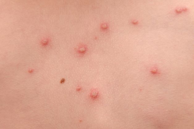 Virus hoặc vi khuẩn có thể là nguyên nhân gây ra tình trạng trẻ bị nổi mẩn đỏ có nước