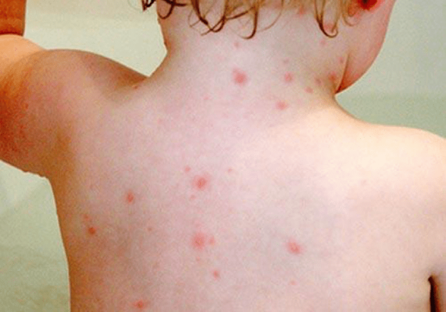 Trẻ bị nổi mẩn đỏ có nước khắp người rất nguy hiểm vì dễ bị virus và vi khuẩn tấn công