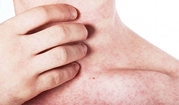 Trẻ bị sốt xuất huyết ở giai đoạn khởi phát, trẻ có triệu chứng xuất huyết lỗ chân lông (hay còn gọi là sung huyết ở da).