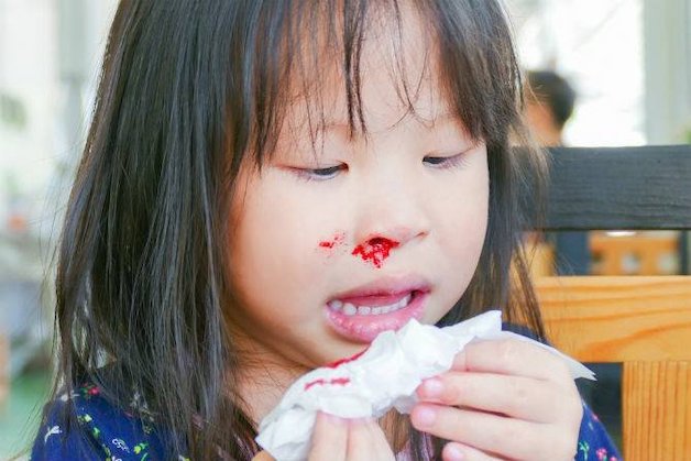 Ở giai đoạn nguy cấp, trẻ còn bị chảy máu mũi.