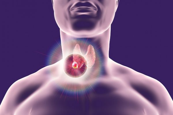 U tuyến giáp ác tính có thể chữa khỏi hoàn toàn nếu được phát hiện sớm và điều trị đúng cách
