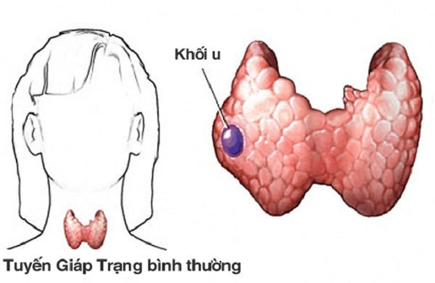Trả lời câu hỏi u tuyến giáp có lây không