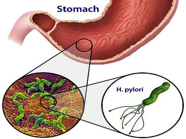 Biết được vi khuẩn Hp là gì giúp mọi người chủ động trong phòng tránh và điều trị