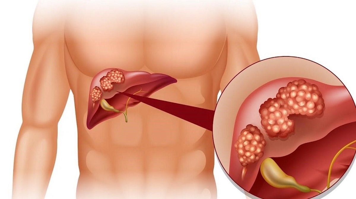 Bác sĩ tư vấn chế độ ăn cho người viêm gan C