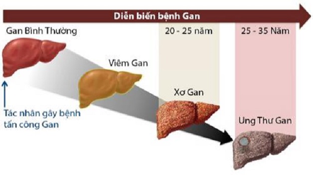 Quá trình diễn biến thành ung thư gan