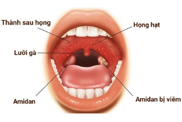 hình ảnh viêm họng hạt mãn tính