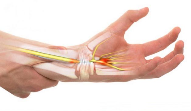 Viêm khớp vùng cổ tay không đơn giản như vẫn tưởng