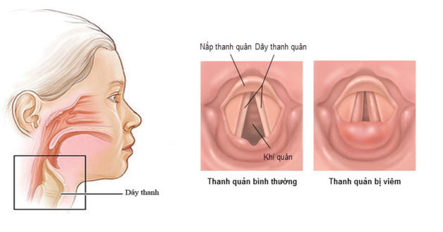 hình ảnh viêm thanh quản