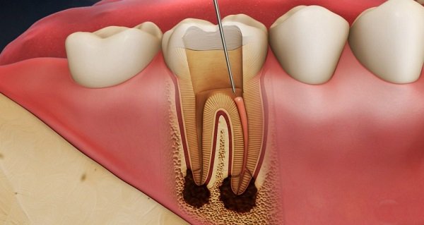 răng cấm lung lay có nên nhổ
