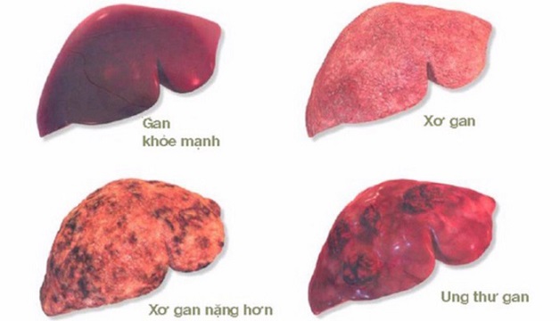 Xơ gan rượu có thể tiến triển thành ung thư gan