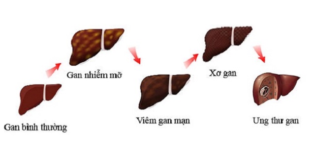 Xơ gan có thể tiển triển thành ung thư gan