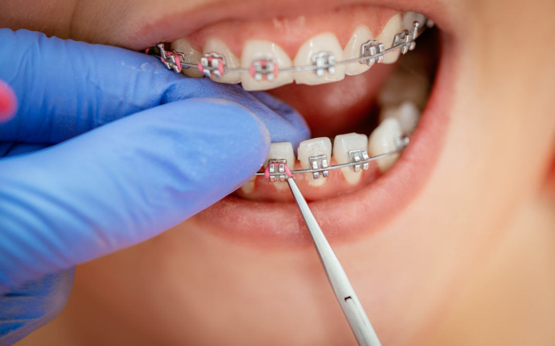 30 tuổi có nên niềng răng