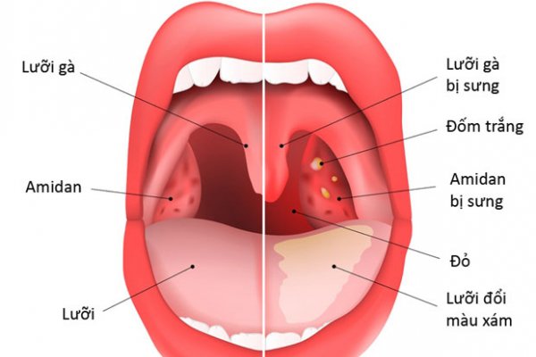 Amidan là một tế bào lympo giúp bảo vệ cơ thể chống lại sự xâm nhập của vi khuẩn