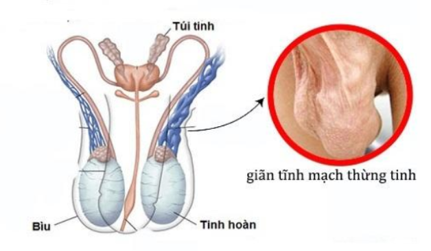 Giãn tĩnh mạch tinh hoàn là nguyên nhân dẫn đến hiện tượng đau tinh hoàn một bên