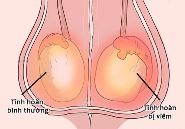 Hiện tượng tinh hoàn bị viêm