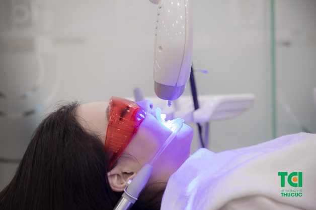 tẩy trắng răng bằng laser