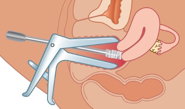 Mỏ vịt được sử dụng với bệnh nhân đã có quan hệ tình dục