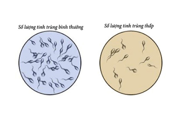 Tổng số tinh trùng lớn hơn 39 triệu/ml tinh trùng là bình thường