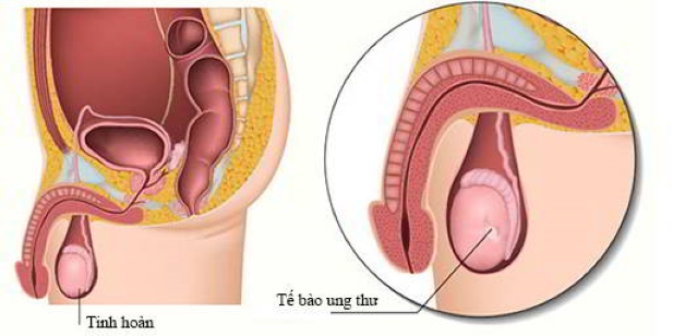 Ung thư tinh hoàn tạo nên những cục cứng bên trong tinh hoàn