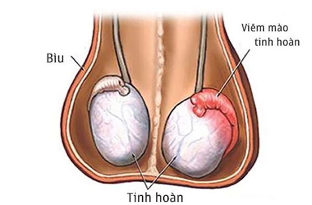Viêm mào tinh hoàn gây cảm giác đau nhói khi giao hợp hoặc xuất tinh