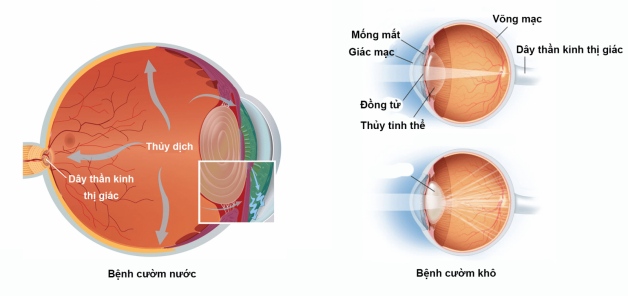 Đcụ thủy tinh thể có thể gặp ở bất kỳ độ tuổi nào nhưng được ghi nhận nhiều nhất là từ 50 trở lên
