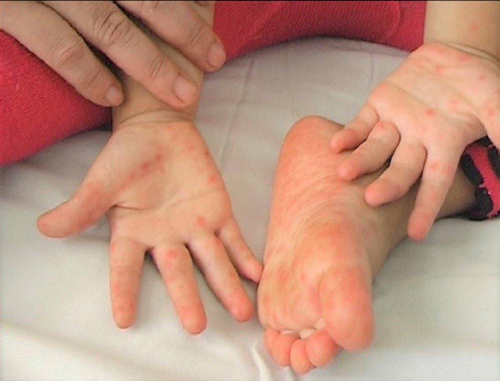Trẻ mắc tay chân miệng trong quá trình phục hồi