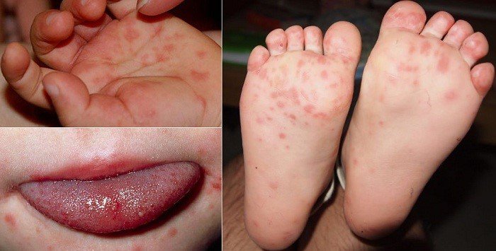 Bệnh tay chân miệng trẻ em có nguy hiểm không là điều nhiều cha mẹ băn khoăn, lo lắng