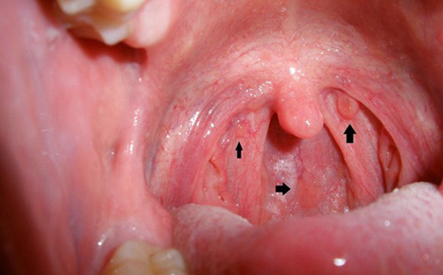 Bệnh ung thư vòm họng có chữa khỏi được không còn phụ thuộc vào nhiều yếu tố